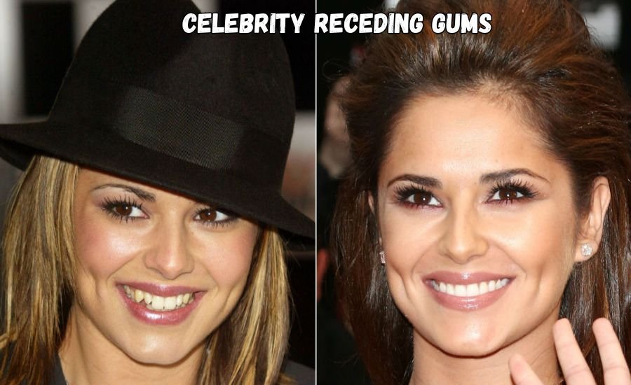 celebrity receding gums