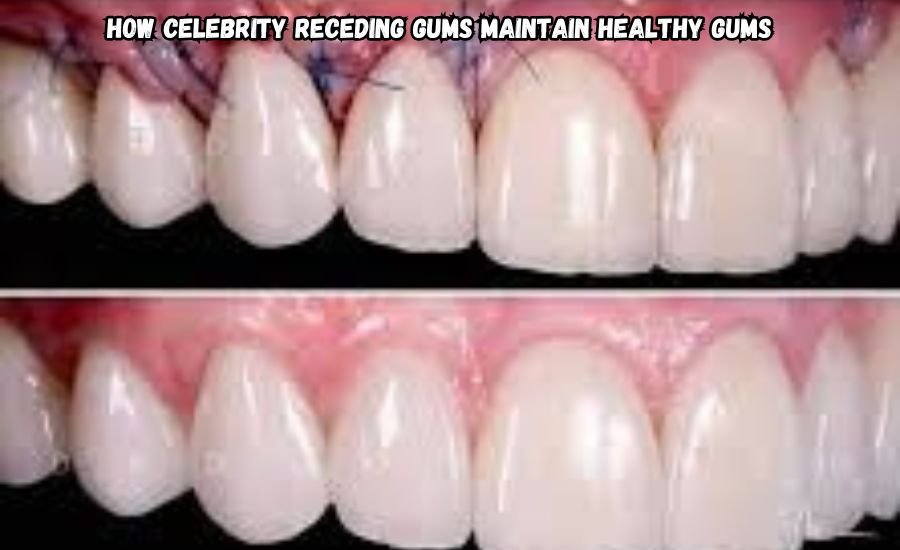 celebrity receding gums